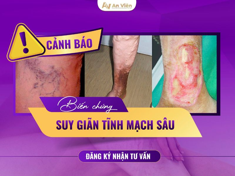 hình ảnh chân bị giãn tĩnh mạch