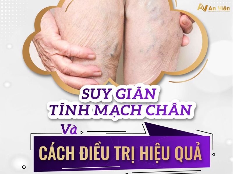 Ngăn ngừa giãn tĩnh mạch ở dân văn phòng qua 5 thói quen 16 ngăn ngừa giãn tĩnh mạch