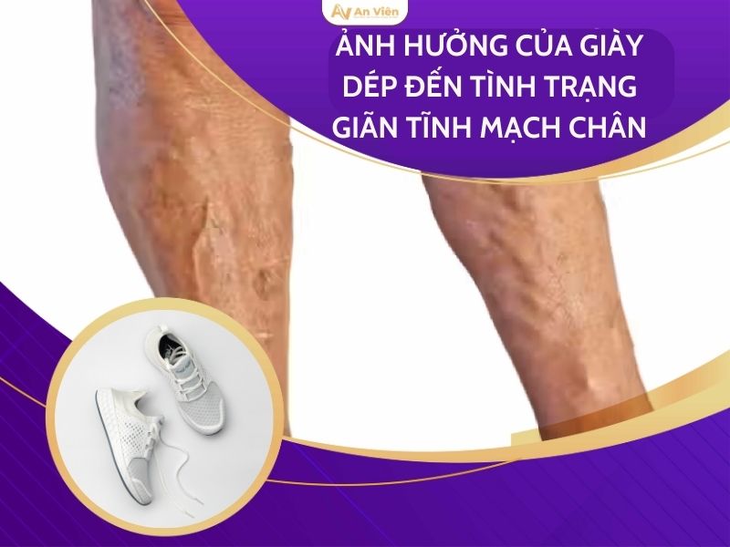 suy giãn tĩnh mạch bàn chân