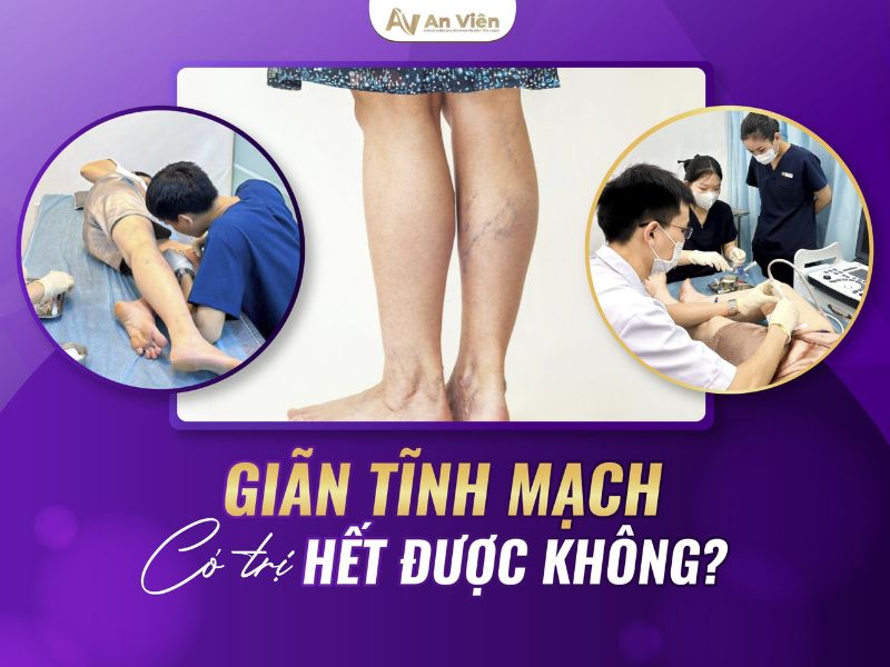 suy tĩnh mạch sâu là gì
