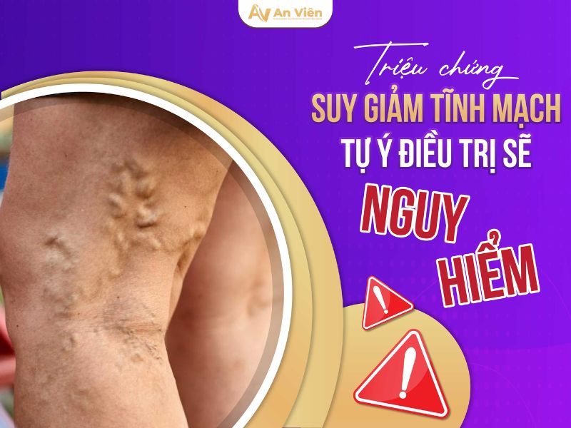 suy tĩnh mạch sâu là gì