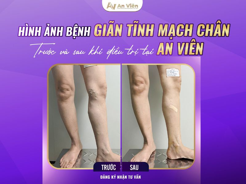 suy tĩnh mạch sâu là gì