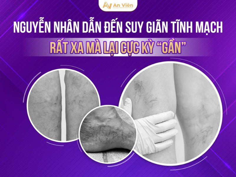 Tại sao bị giãn tĩnh mạch ở chân ở giới trẻ ngày càng nhiều? 10 Tại sao bị giãn tĩnh mạch ở chân