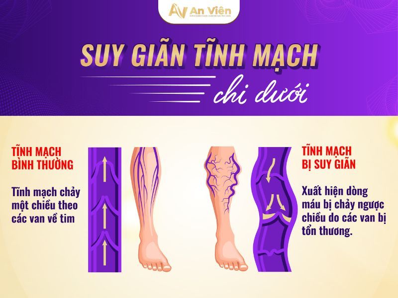 Lý do vì sao bị giãn tĩnh mạch chân? Bạn đã biết? 10 vì sao bị giãn tĩnh mạch chân