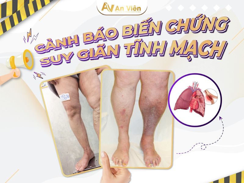 Lý do vì sao bị giãn tĩnh mạch chân? Bạn đã biết? 11 vì sao bị giãn tĩnh mạch chân