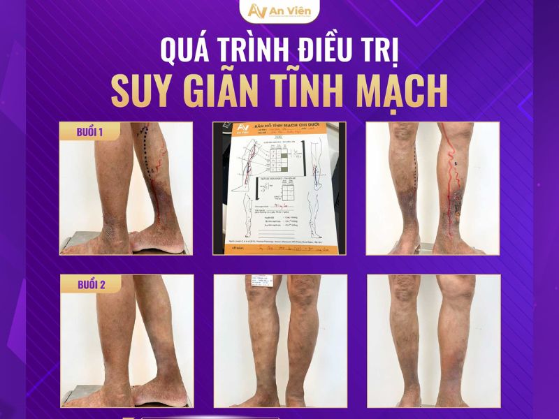 Lý do vì sao bị giãn tĩnh mạch chân? Bạn đã biết? 13 vì sao bị giãn tĩnh mạch chân