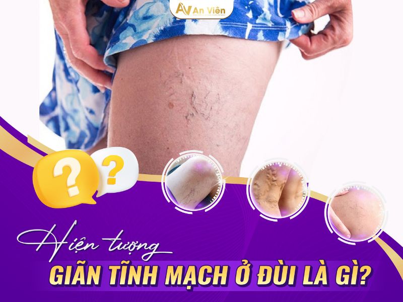 biểu hiện suy giãn tĩnh mạch
