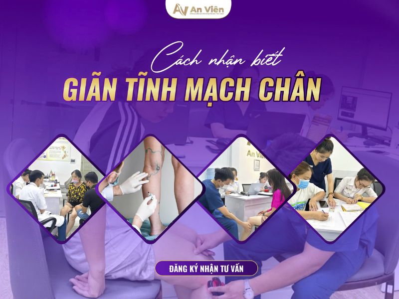 biểu hiện suy giãn tĩnh mạch
