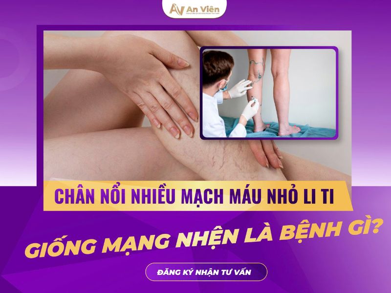biểu hiện suy giãn tĩnh mạch
