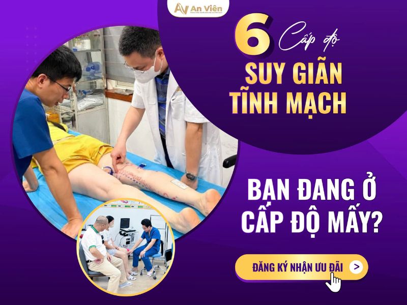 biểu hiện suy giãn tĩnh mạch
