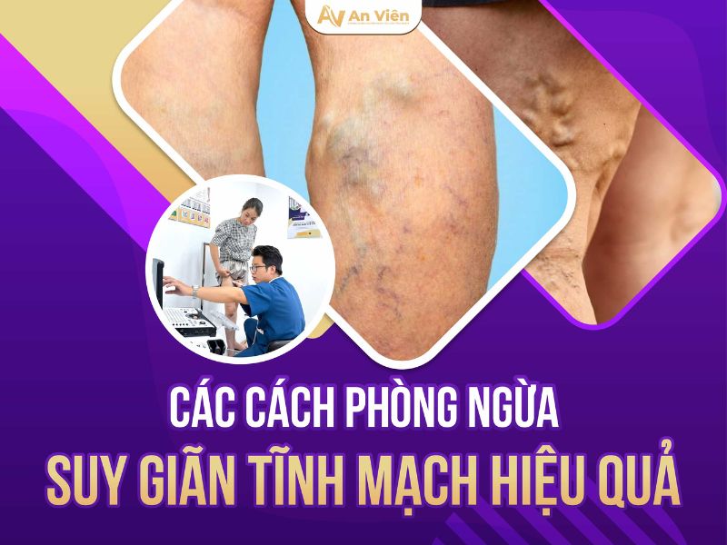 biểu hiện suy giãn tĩnh mạch
