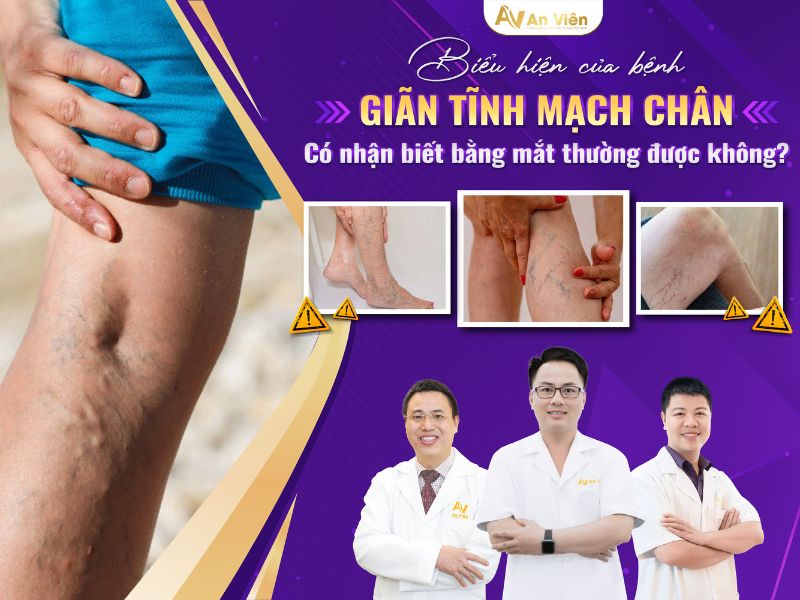 Chân nổi nhiều mạch máu nhỏ là bệnh gì? Điều trị triệt để 11 chân nổi nhiều mạch máu nhỏ