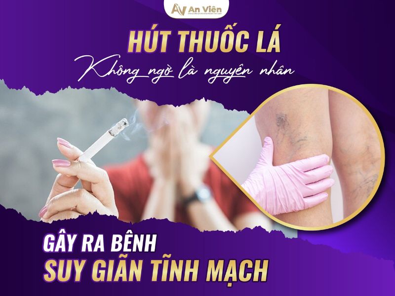 Tìm hiểu 2 nhóm nguyên nhân bị giãn tĩnh mạch ở chân 13 nguyên nhân bị giãn tĩnh mạch ở chân