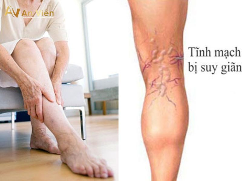 Tìm hiểu 2 nhóm nguyên nhân bị giãn tĩnh mạch ở chân 14 nguyên nhân bị giãn tĩnh mạch ở chân