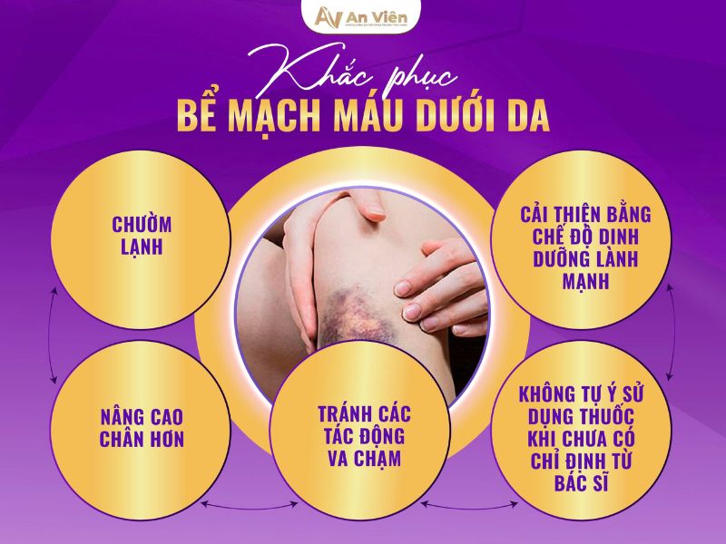 6 cách phòng chống suy giãn tĩnh mạch giúp bạn đối phó nhanh 11 cách phòng chống suy giãn tĩnh mạch