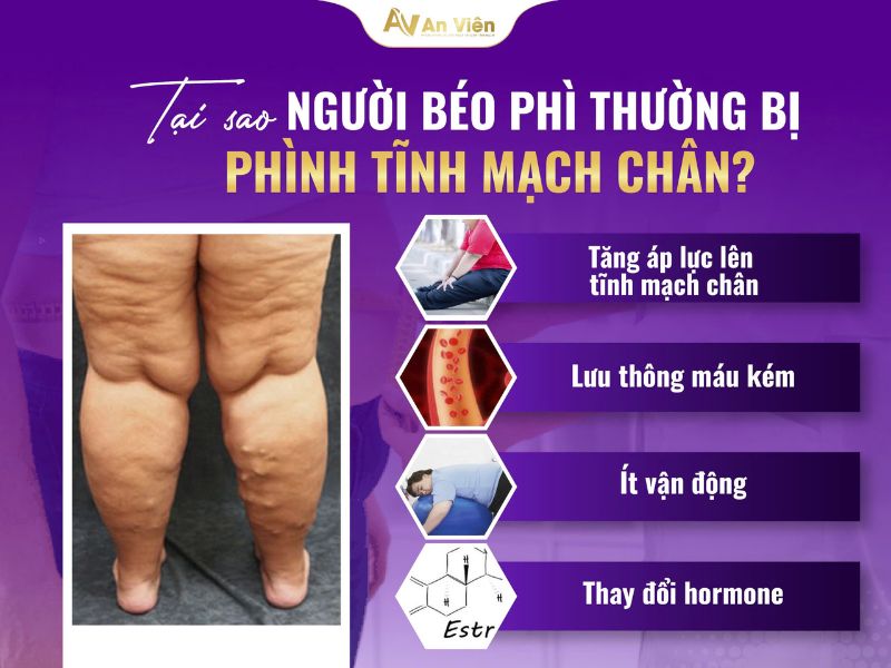phình tĩnh mạch chân