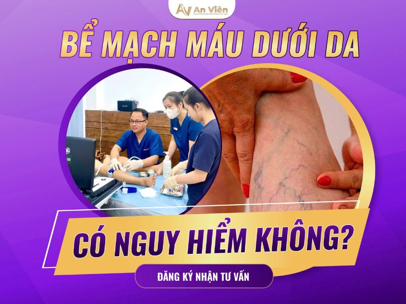 phình tĩnh mạch chân