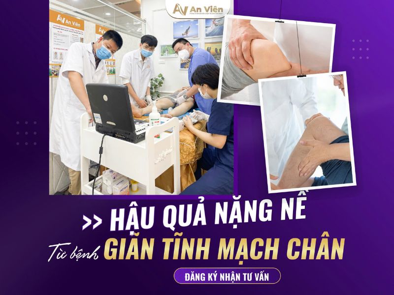 phình tĩnh mạch chân