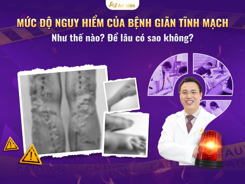 phình tĩnh mạch chân