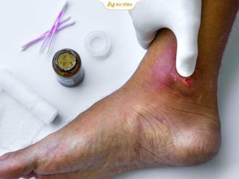 Loét da chân là gì? Nguyên nhân, dấu hiệu và cách điều trị 15 Loét da chân có tự khỏi không?