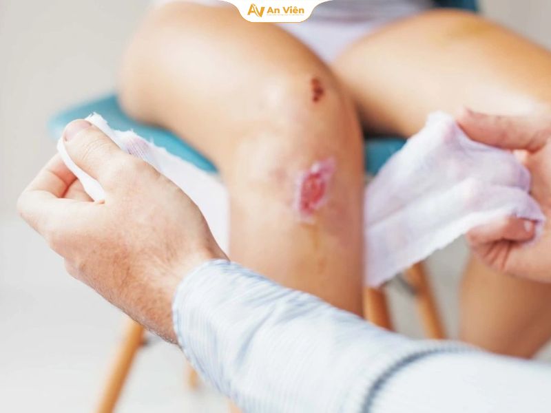 Loét da chân là gì? Nguyên nhân, dấu hiệu và cách điều trị 16 Kiểm soát nhiễm trùng và làm sạch vết loét