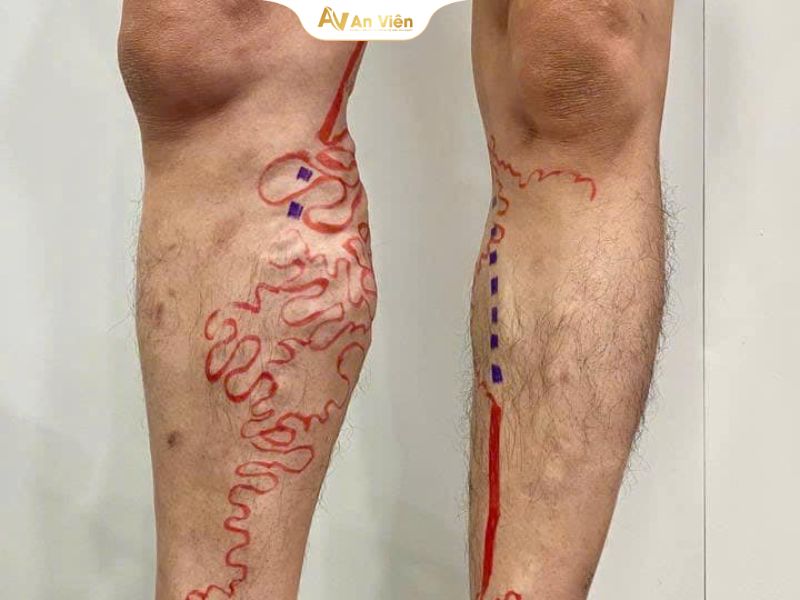 Xúc động lời cảm ơn từ trái tim của bệnh nhân suy giãn tĩnh mạch được bác sĩ Thành giải cứu khỏi cơn đau 5 Suy giãn tĩnh mạch
