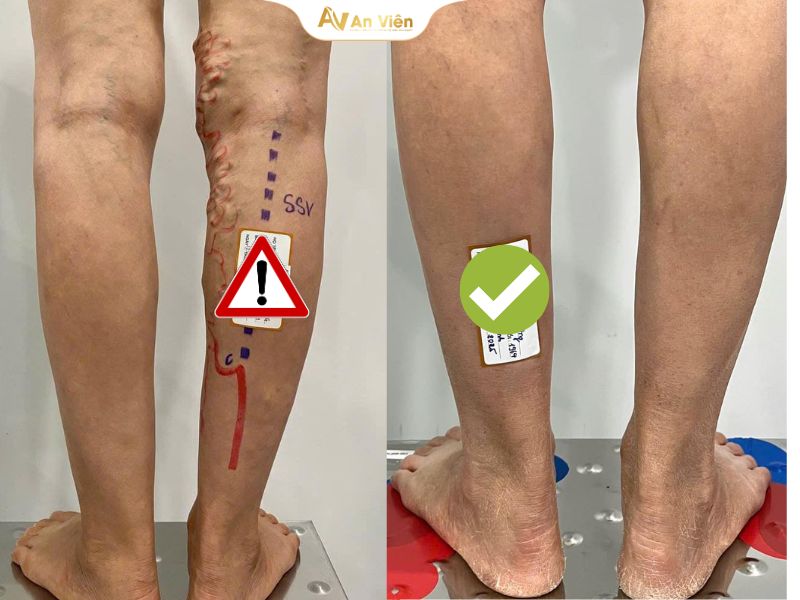 Xúc động lời cảm ơn từ trái tim của bệnh nhân suy giãn tĩnh mạch được bác sĩ Thành giải cứu khỏi cơn đau 8 Suy giãn tĩnh mạch