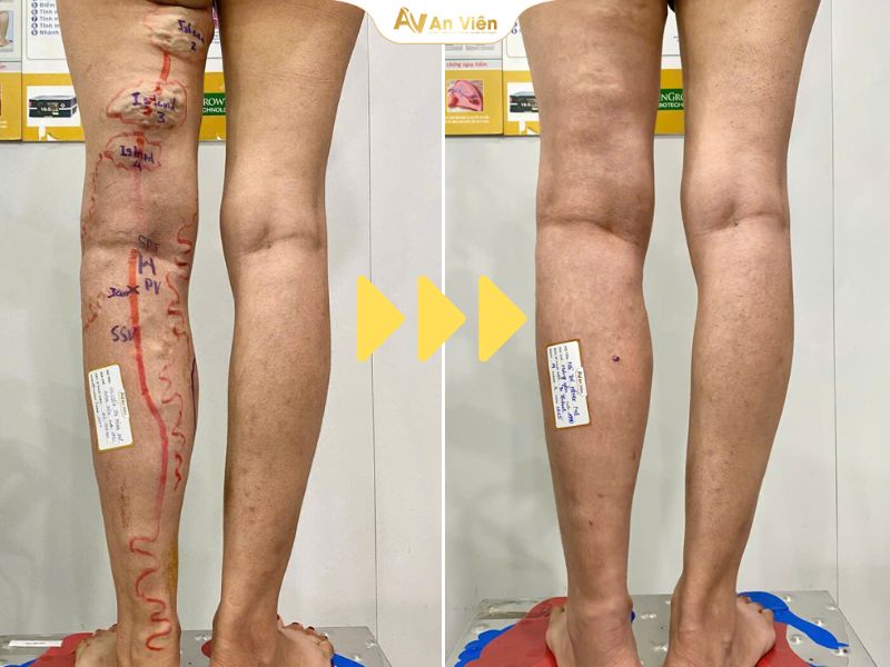 Tĩnh mạch An Viên triển khai ứng dụng công nghệ trị SGTM không mổ thành công với hơn 10.000 ca 10 Tĩnh mạch An Viên triển khai ứng dụng công nghệ