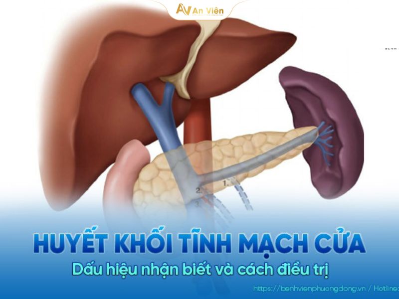 Tĩnh mạch gánh là gì và những vấn đề cần lưu ý 14 tĩnh mạch gánh