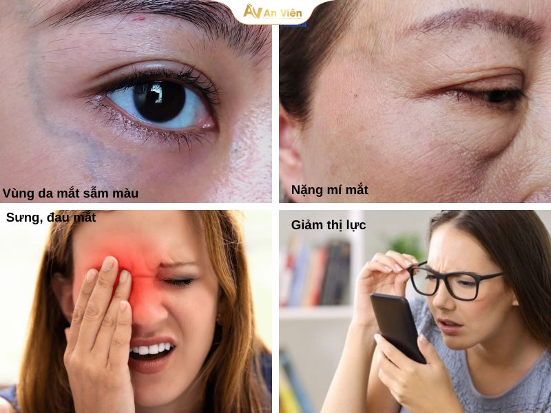 Giãn tĩnh mạch mắt là gì? Nguyên nhân, triệu chứng và cách điều trị 10 Giãn tĩnh mạch mắt là gì