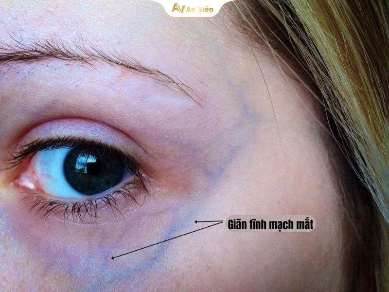 Giãn tĩnh mạch mắt là gì? Nguyên nhân, triệu chứng và cách điều trị 7 Giãn tĩnh mạch mắt là gì