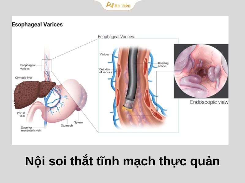 Giãn tĩnh mạch thực quản độ 1 trên nội soi