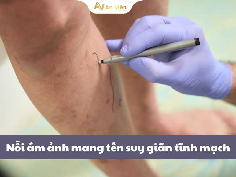 Chữa suy giãn tĩnh mạch tại An Viên