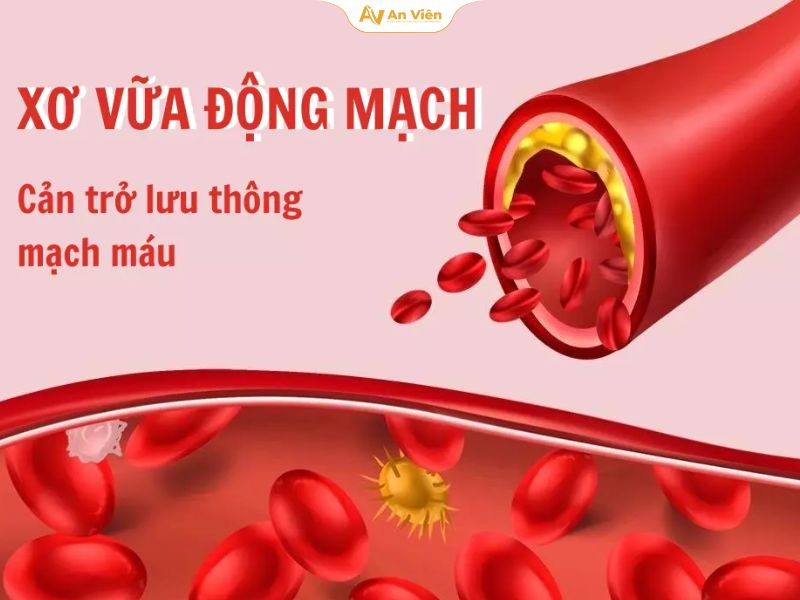 Xơ vữa động mạch