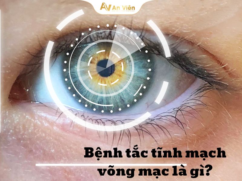 tắc tĩnh mạch võng mạc