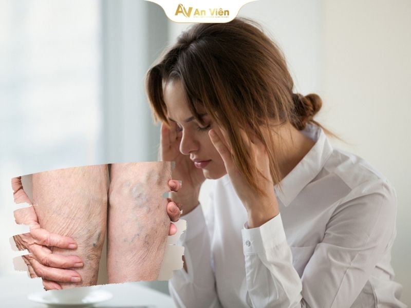 Bị nổi mạch máu đỏ dưới da chân là bệnh gì? Nguyên nhân và cách điều trị 8 Bị nổi mạch máu đỏ dưới da chân