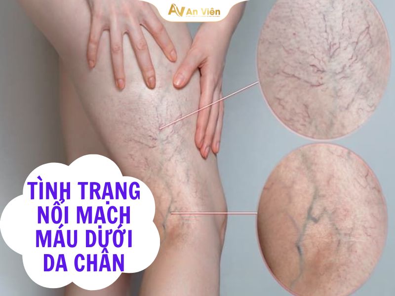 Bị nổi mạch máu đỏ dưới da chân là bệnh gì? Nguyên nhân và cách điều trị 7 Bị nổi mạch máu đỏ dưới da chân