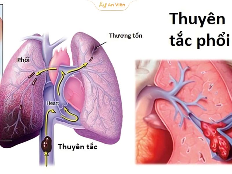 Dấu hiệu tắc nghẽn mạch máu