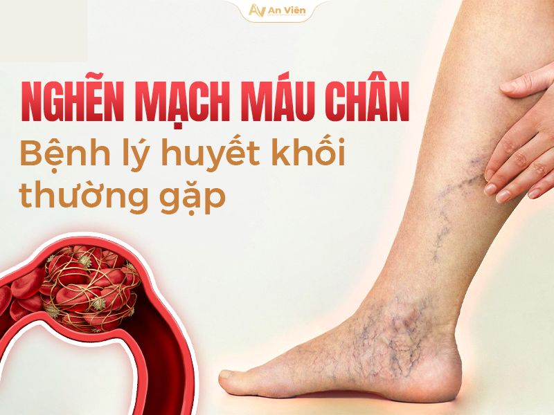 Dấu hiệu tắc nghẽn mạch máu chân