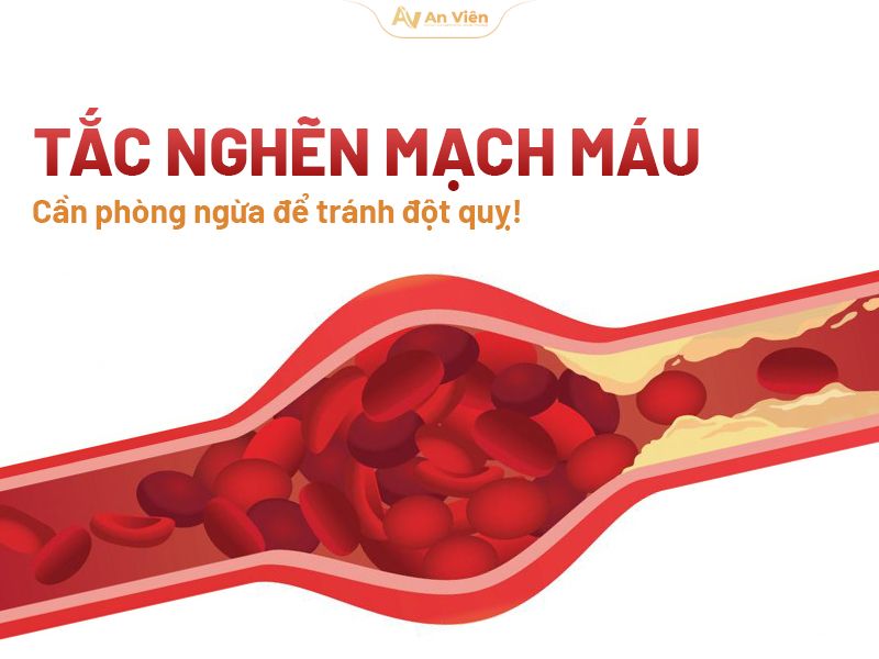 Tắc nghẽn mạch máu: Nguyên nhân, dấu hiệu và cách phòng ngừa 12 Tắc nghẽn mạch máu