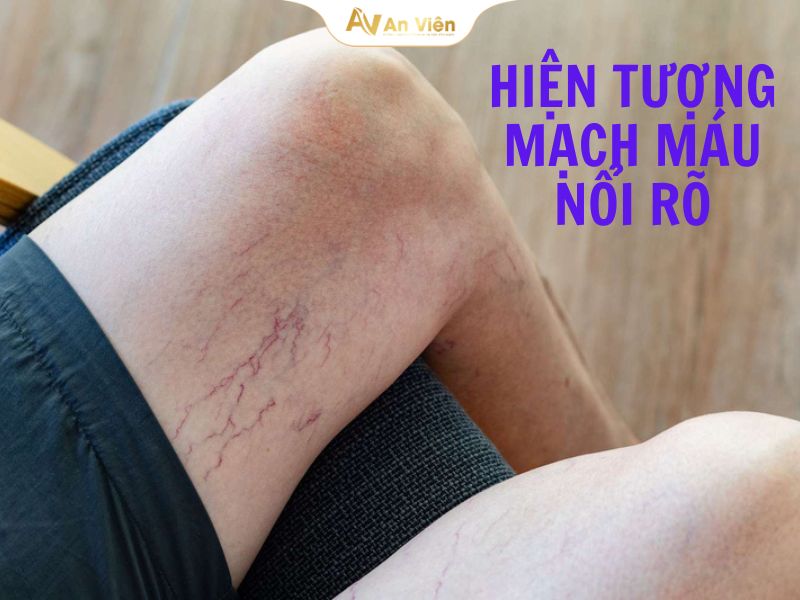 Mạch máu nổi rõ và cách xử lý hiệu quả, an toàn nhất 5 mach-mau-noi-ro
