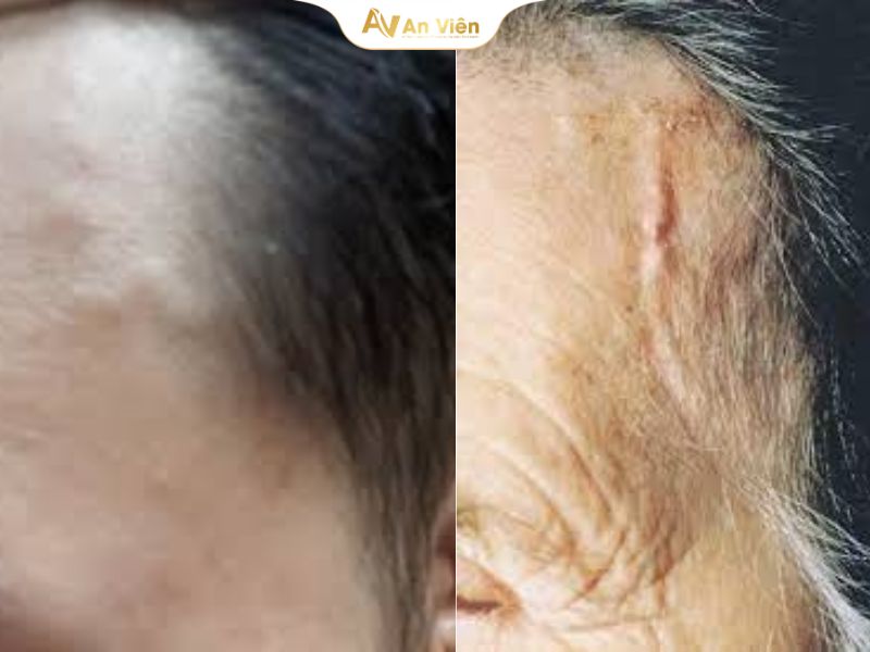 Bị nổi mạch máu ở thái dương và cách xử lý hiệu quả 8 nổi mạch máu ở thái dương