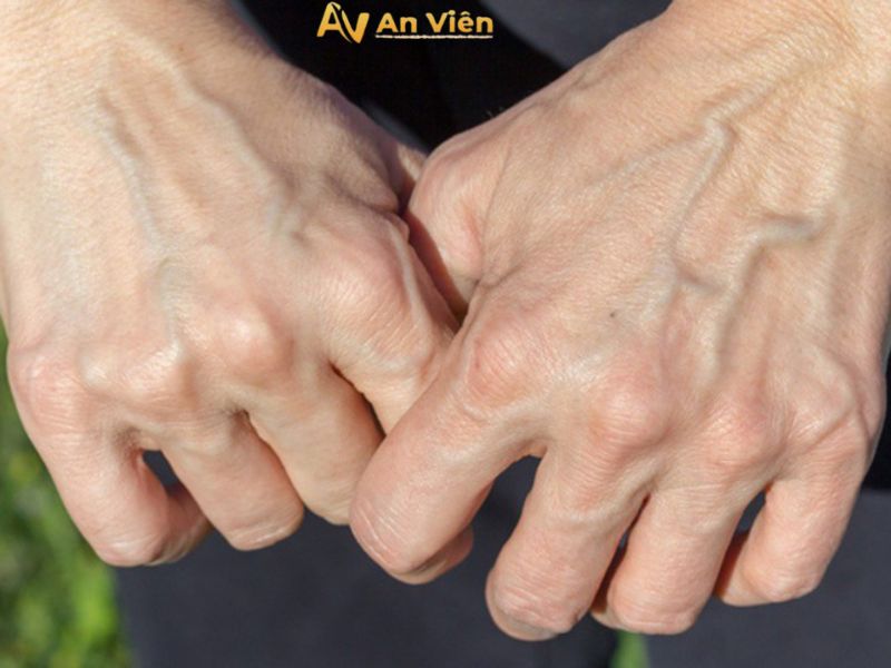 Tắc nghẽn mạch máu ở tay: Nguyên nhân, dấu hiệu và cách điều trị 11 tac-nghen-mach-mau-o-tay
