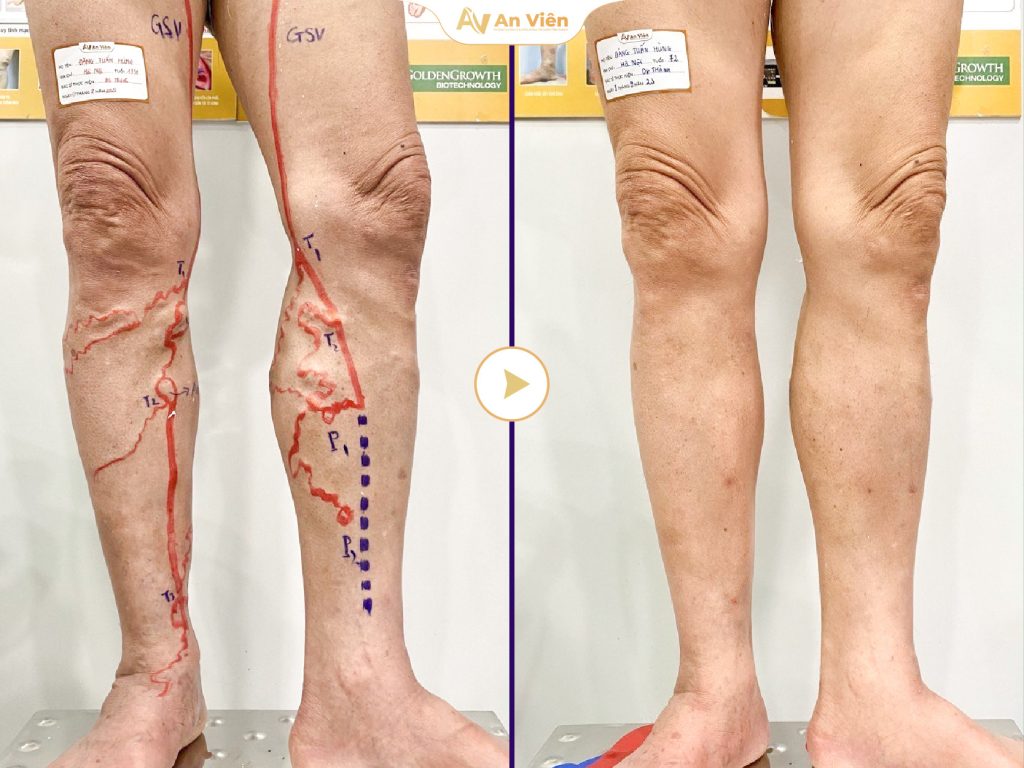 Laser nội mạch EVLA