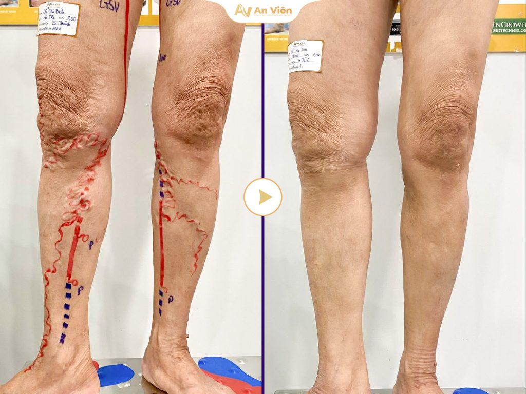 Laser nội mạch EVLA