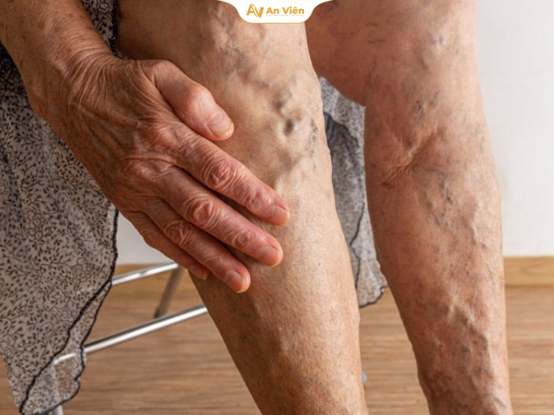 Giãn tĩnh mạch có bị phù chân không? 8 mẹo đơn giản giúp hết sưng ngủ ngon 16 Giãn tĩnh mạch có bị phù chân không