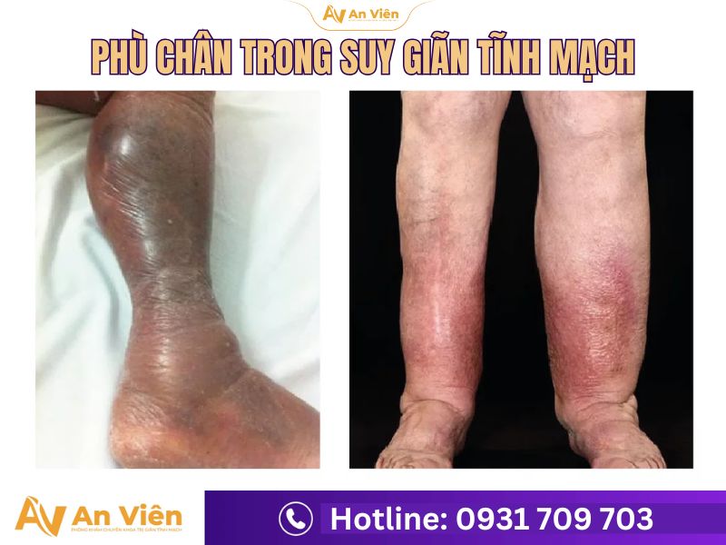 Giãn tĩnh mạch có bị phù chân không? 8 mẹo đơn giản giúp hết sưng ngủ ngon 13 Giãn tĩnh mạch có bị phù chân không
