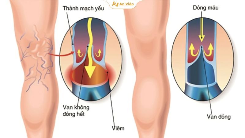 Giãn tĩnh mạch có di truyền không