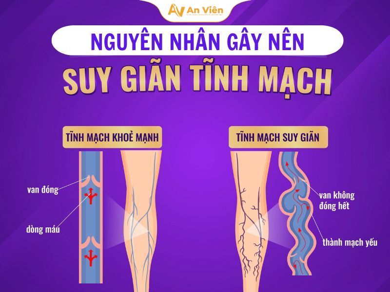 Giãn tĩnh mạch có di truyền không