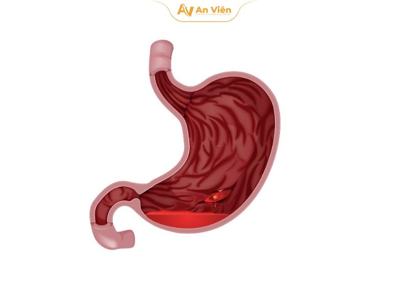 Giãn tĩnh mạch thực quản độ 2 là gì? Nguyên nhân, triệu chứng và phương pháp điều trị hiệu quả 9 Nhoi mau nao 1 6
